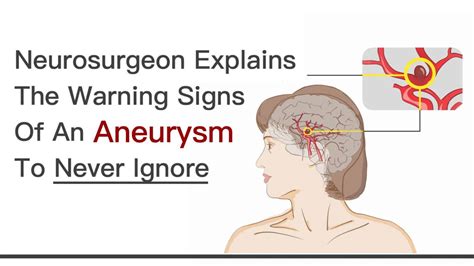 Brain Surgeon Explains the Warning Signs of An Aneurysm to Never Ignore