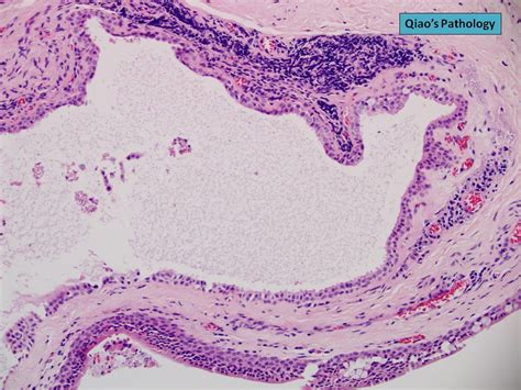 Qiao's Pathology: Conjunctival Epithelial Inclusion Cyst (… | Flickr