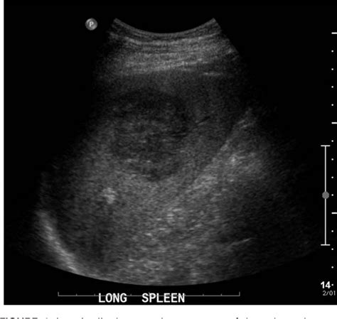 Figure 1 from Contrast-enhanced ultrasound features of primary splenic lymphoma. | Semantic Scholar