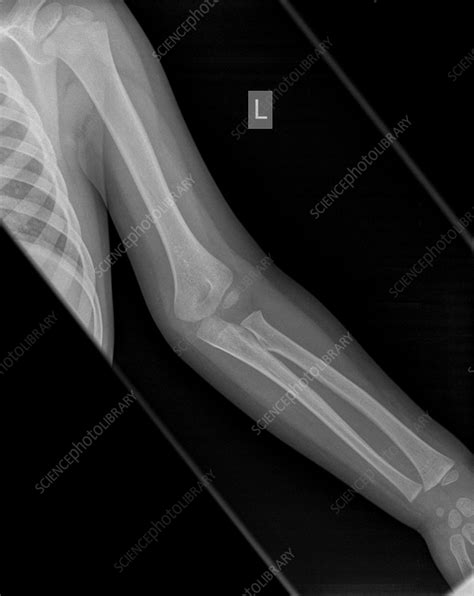 Supracondylar humerus fracture, X-ray - Stock Image - C056/4172 ...