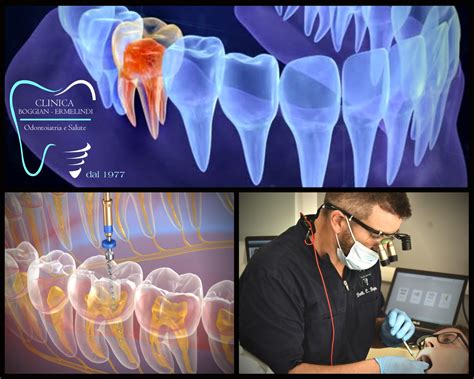 La devitalizzazione, un intervento conservativo e indolore - Boggian Clinica Dentale