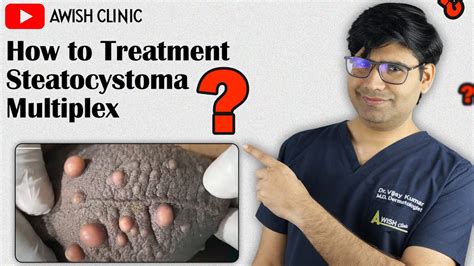 Steatocystoma Multiplex disease in Boys | AwishClinic.com - YouTube