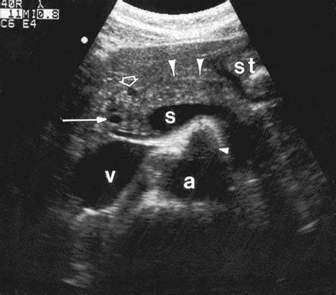 Pancreas Normal Anatmoy: Transverse scan in which are visible the ...