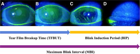 Maximum blink interval is associated with tear film breakup time: A new simple, screening test ...