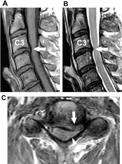 Cervical cord compression on MRI. (A) T1- and (B) T2-weighted sagittal ...