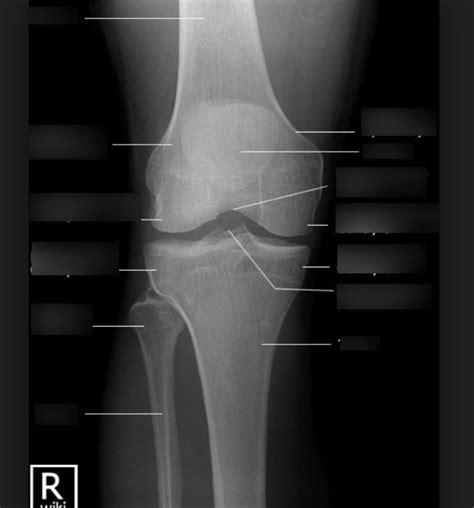 AP knee x ray Diagram | Quizlet