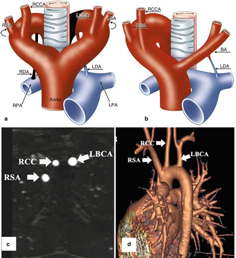 Aortic Arch Anomalies | Radiology Key