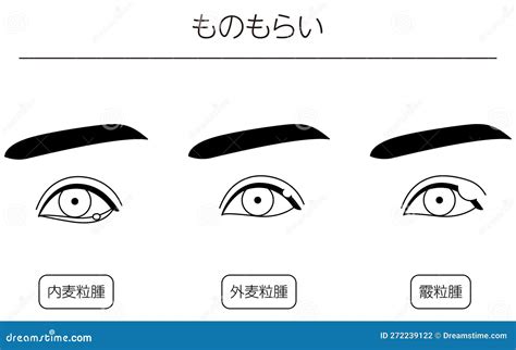 Medical Clipart, Line Drawing Illustration Of Eye Disease And Sty, Chalazia | CartoonDealer.com ...