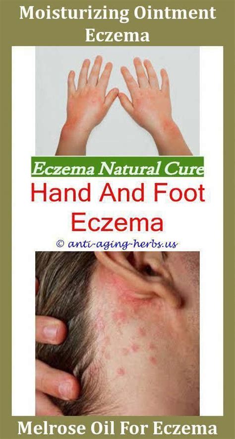 Vitamin D Eczema Cure