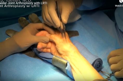 Thumb Basilar Joint Arthroplasty — OrthopaedicPrinciples.com