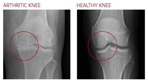 Total Knee Replacement - Dr. Bu Balalla