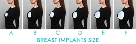 Polaris - Breast Augmentation with Implants