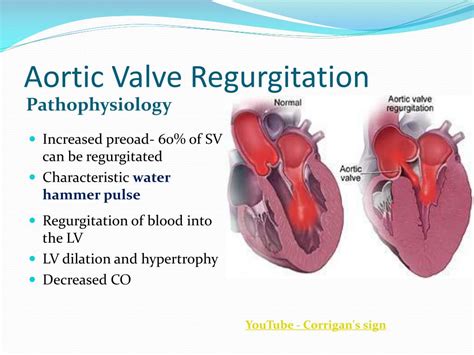 PPT - Valvular Heart Disease Cardiomyopathy and Aneursyms PowerPoint Presentation - ID:4501126