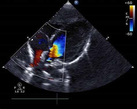 Mitral Valve Stenosis Stock Photos, Pictures & Royalty-Free Images - iStock