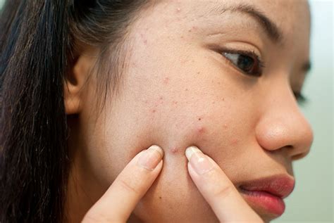 Getting Rid of Pimple Infected Skin ~ Health Safety Tips