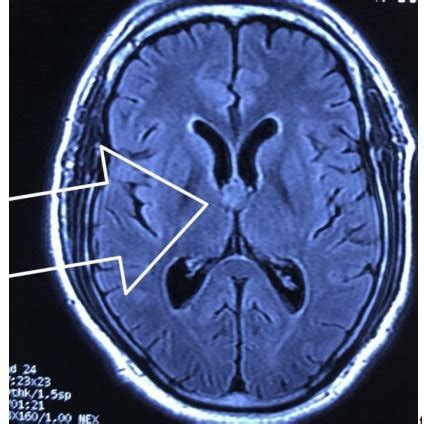 Endoscopic View of Foramen of monro with Choroid plexuses and the ...