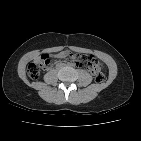 Normal CT abdomen and pelvis: triphasic protocol | Image | Radiopaedia.org