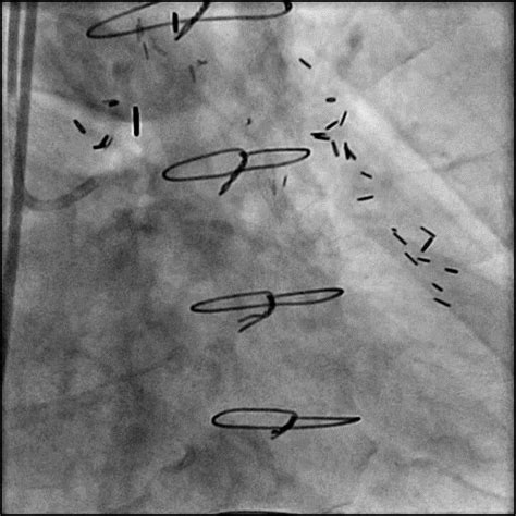 Bypass Graft - Case 1 - Cardiology Apps