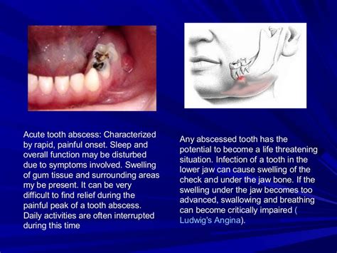 Acute apical-periodontitis.25.mar.2013