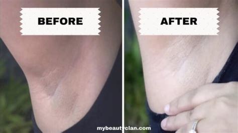 🥇 The Ordinary Glycolic Acid For Your Armpits | My Beauty Clan