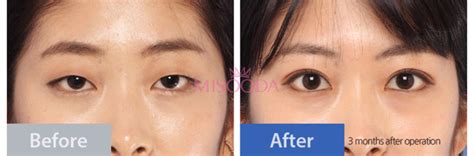 WHY Korean Eyelid Surgery? Guide, Reviews, Images, Promotions | MISOODA