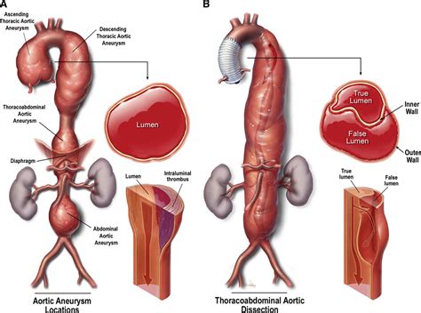 Aneurysm Aorta : Ascending aortic aneurysms develop in the section of ...