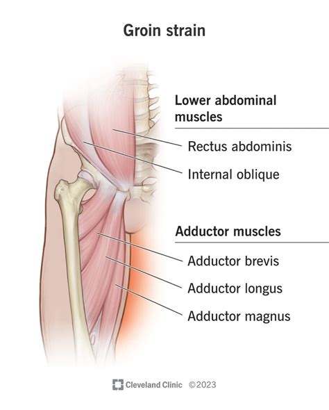 Groin Strain: Causes, Symptoms, Tests & Treatments