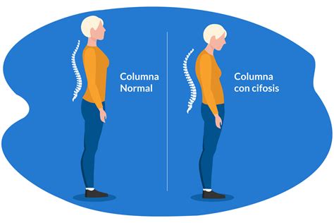 Cifosis: qué es, síntomas, causas y tratamiento 👨‍⚕️