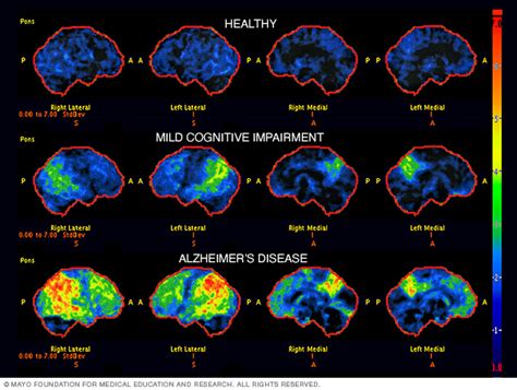 Alzheimer's disease - Diagnosis and treatment - Mayo Clinic