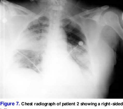 [PDF] Ludwig's Angina: Diagnosis and Treatment | Semantic Scholar