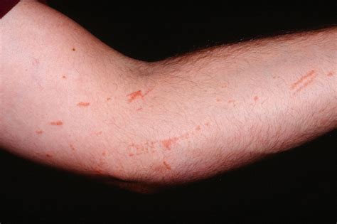 Poison Ivy Rash - Causes, How To Identify Poison Ivy Rash & Treatment