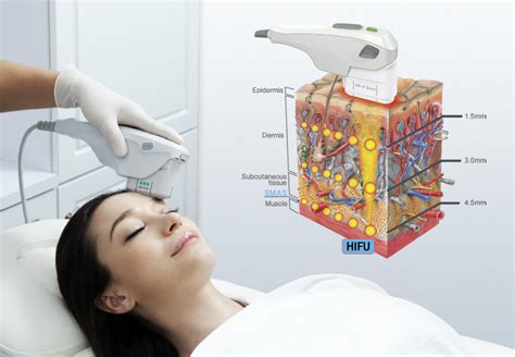 Расскажем о 4d hifu smas что за аппарат