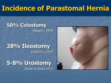 PPT - Parastomal Hernia Repair PowerPoint Presentation, free download ...