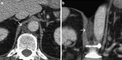 CT of a 63-year-old man with lung cancer metastasized to the brain. (a)... | Download Scientific ...