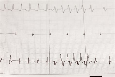 Arrhythmia: Causes, symptoms, types, and treatment