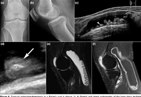 Figure 8 from Sonography of Baker’s Cyst (Popliteal Cyst): the Typical ...