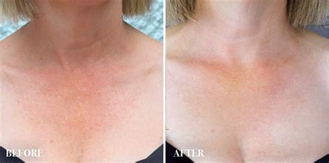 CULT51 Neck & Décolleté has Revealed some Amazing Results | Skin so ...