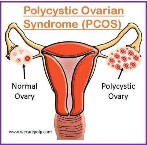 Polycystic Ovarian Syndrome (PCOS) - We Care