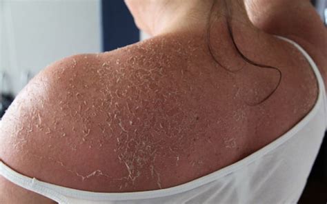 How To Stop Peeling Skin From Sunburn?