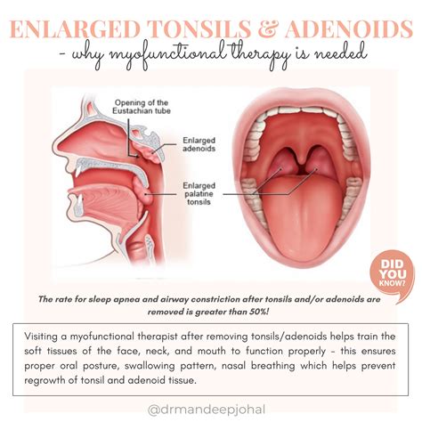 Tonsil Removal and Myofunctional Therapy - Family Dental Centre