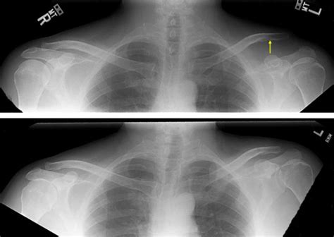 AC Joint Injury | Acromioclavicular Joint Pain | Vail, Aspen, Denver CO