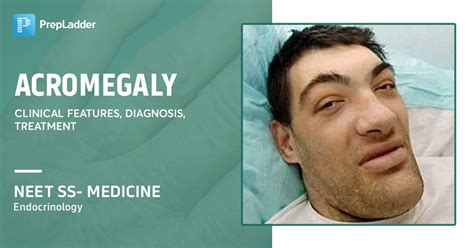 Acromegaly- Clinical Features, Diagnosis, Treatment