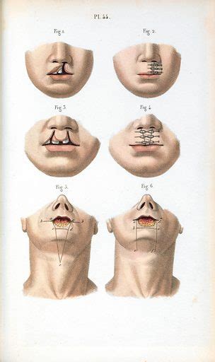 Cheiloplasty. Surgical techniques for repairing various types … free public domain image | Look ...