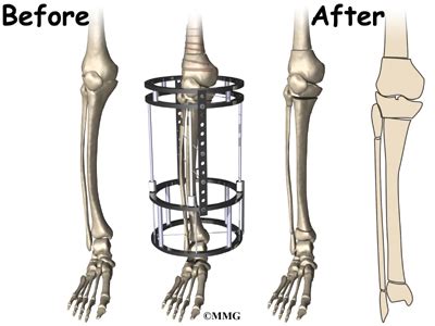 Blount's Disease - Midwest Bone and Joint Institute - Illinois