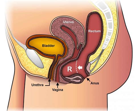 Pessary for uterine prolapse, pessary fitting, insertion, care, removal & complications