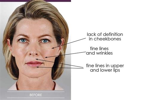 Your Guide to Juvederm Types: Voluma, Volbella & Vollure | Voluma, Juvederm, Laser skin care