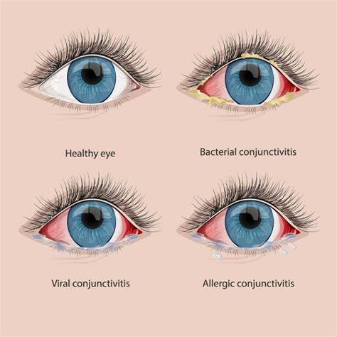 Conjunctivitis. What it is, treatment and causes | Plano Eye Care