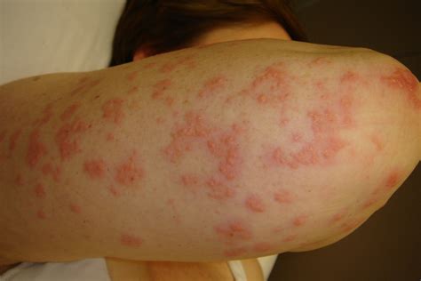 ACD A-Z of Skin - Dermatitis Herpetiformis