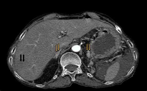 Axial section in arterial phase showing hypodense lesion in segment VII... | Download Scientific ...