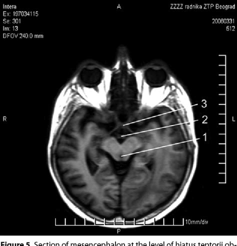 Figure 4 from Anatomical and MRI relations of the cerebral aqueduct to the adjacent parts of the ...